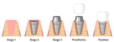 Spécialiste implant dentaire à Blagnac 31